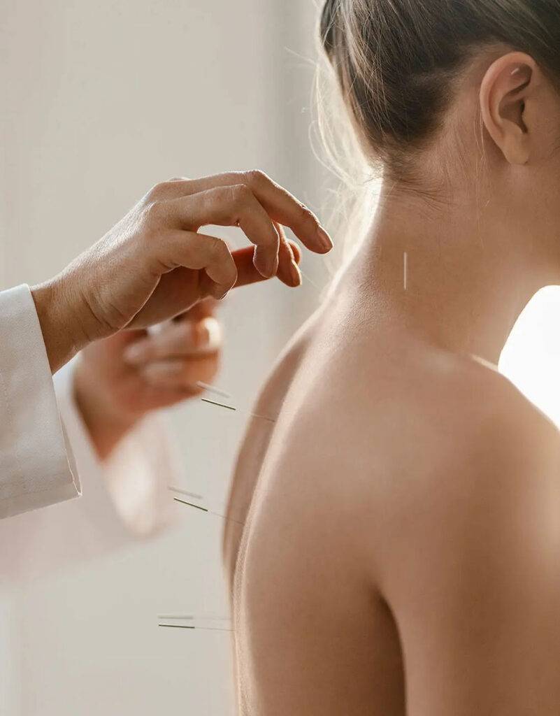 Patient receiving dry needling to back